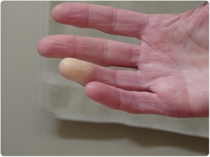 Picture of patient with Raynaud's syndrome - hand is turning white in response to cold temperature - taken By Barb Elkin