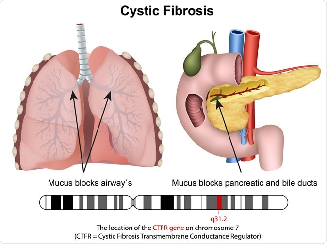 Cystric fibrosis 3d medical vector illustration. Image Credit: medicalstocks / Shutterstock