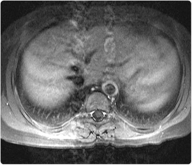 15 year-old female patient with known Takayasu arteritis presented for MRI to investigate back pain. The axial T1-weighted post-gadolinium MRI above shows thickened, enhancing aortic wall, consistent with large vessel vasculitis. Dr Laughlin Dawes, http://www.radpod.org/2007/04/15/takayasu-arteritis