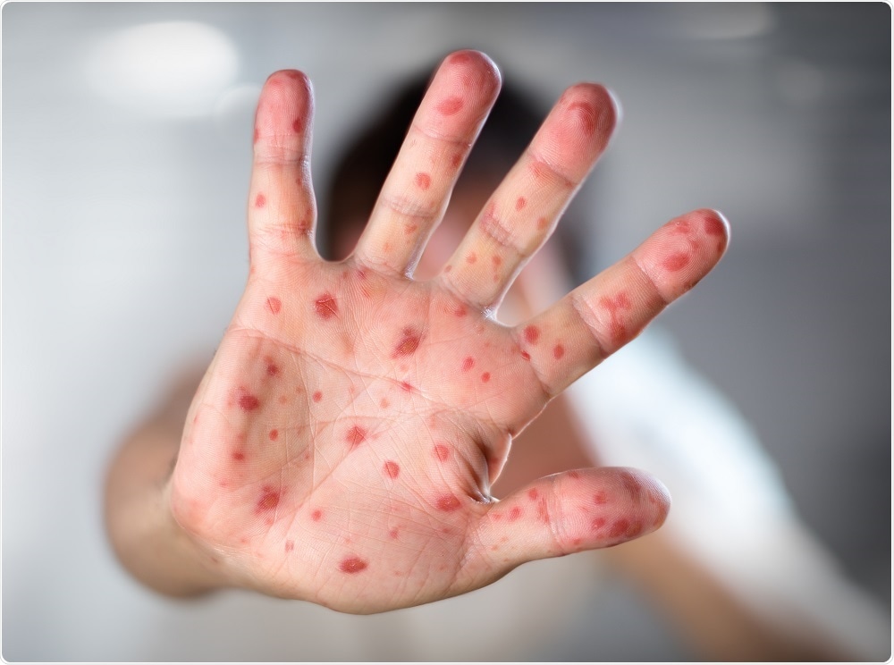 Child with measles