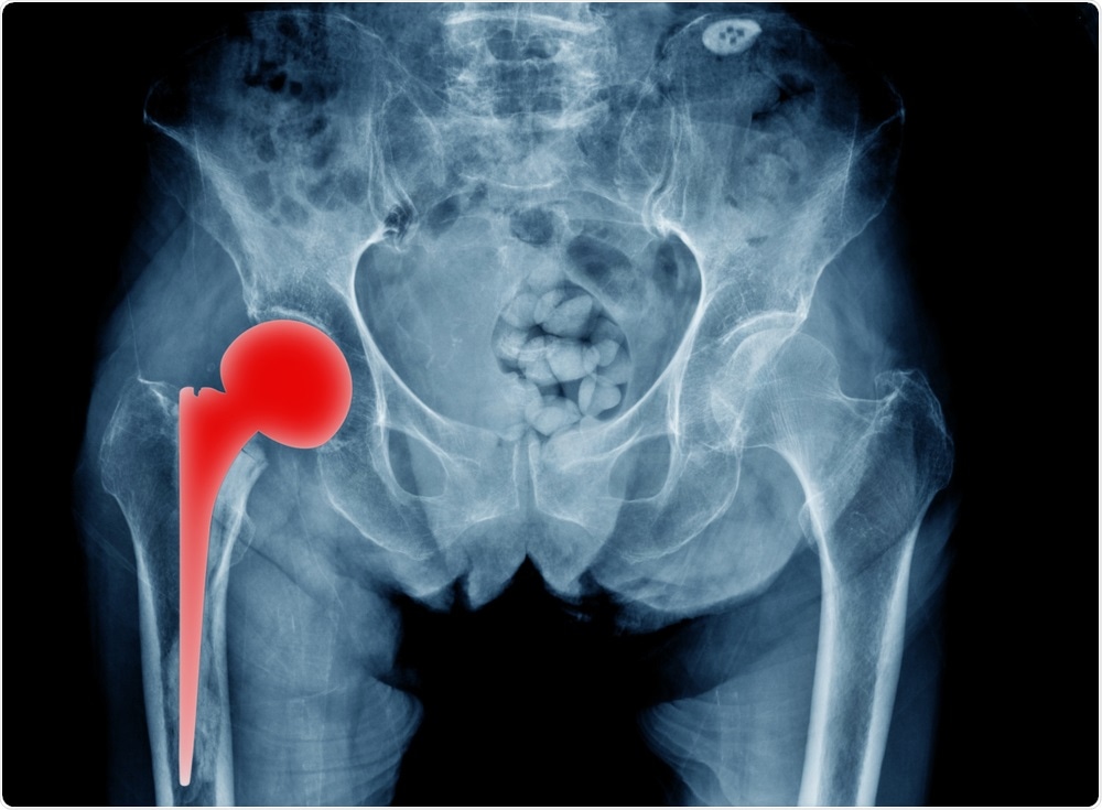 Titanium hip replacement - x ray of patient