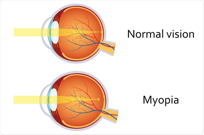 Myopia. Image Credit: Neokryuger / Shutterstock Myopia. Image Credit: Neokryuger / Shutterstock