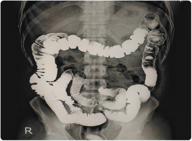 Enema del bario de la radiografía que muestra la mucosa normal del colon. Haber de imagen: Foto/Shutterstock de Richman