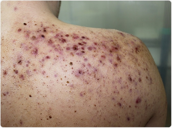 A case of severe form of acne vulgaris (acne conglobata) in a young male. Image Credit: Dermatology11 / Shutterstock