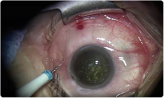 Vitrectomy for severe asteroid hyalosis. Image Credit: Calvin Mein / Shutterstock