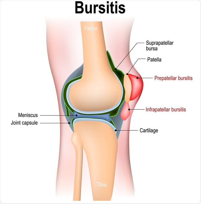 Bursitis - inflammation of bursae (synovial fluid). Prepatellar bursitis (housemaid's knee) and Infrapatellar bursitis - Illustration Credit: Designua / Shutterstock