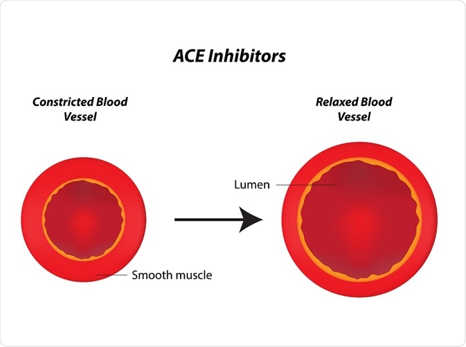 Angiotensin-converting enzyme (ACE) inhibitors are drugs used to treat high blood pressure and congestive heart failure.