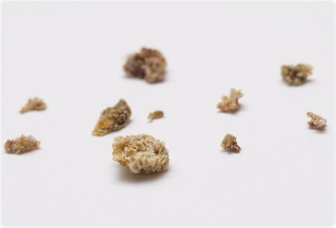 Bisphosphonate-associated osteonecrosis of the jaw. Credit paparutzi / Flickr Bisphosphonate-associated osteonecrosis of the jaw. Credit paparutzi / Flickr