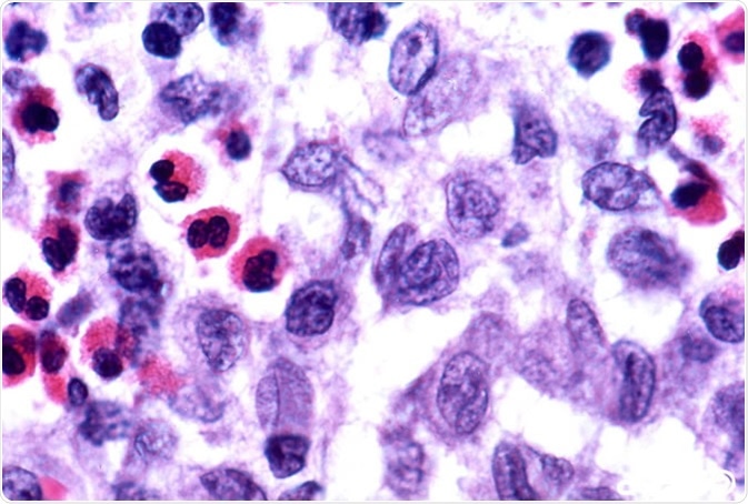 'Langerhans cell histiocytosis' by Pulmonary Pathology is licensed under CC BY-SA 2.0