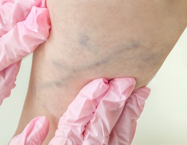 Research could offer new hope for the prevention, treatment of deep vein thrombosis Research could offer new hope for the prevention, treatment of deep vein thrombosis
