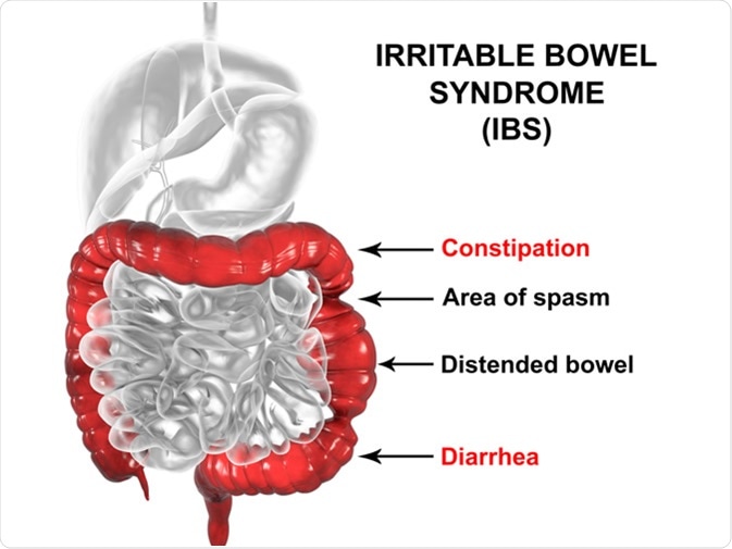 Irritable bowel syndrome IBS, 3D illustration showing spasms and distortion of large intestine. Image Credit: Kateryna Kon / Shutterstock