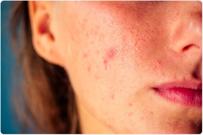 Post-acne, scars and red pimples on the face of a young woman. Image Credit: Yurakrasil / Shutterstock