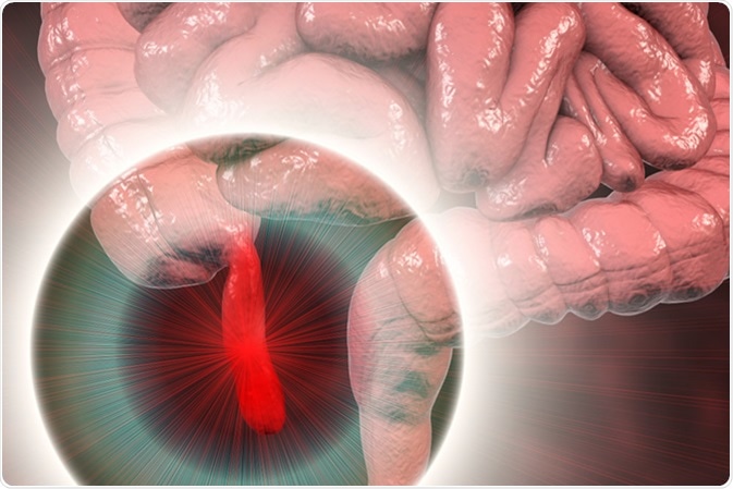 Acute appendicitis, 3D illustration showing inflammed appendix on the cecum. Image Credit: Kateryna Kon / Shutterstock