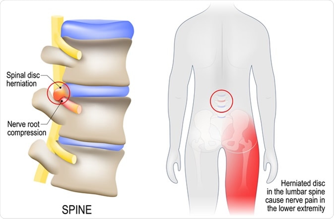 Sciatica diagram with vertebrae, disks and nerves - Image Credit: Designua / Shutterstock