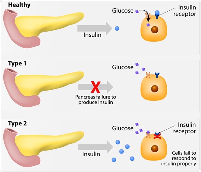Main types of diabetes mellitus. Either the pancreas not producing enough insulin or the cells of the body not responding properly to the insulin produced. Image Credit: Designua / Shutterstock