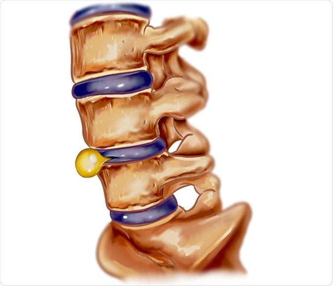 Slipped disc illustration. Image Credit: corbac40 / Shutterstock Slipped disc illustration. Image Credit: corbac40 / Shutterstock