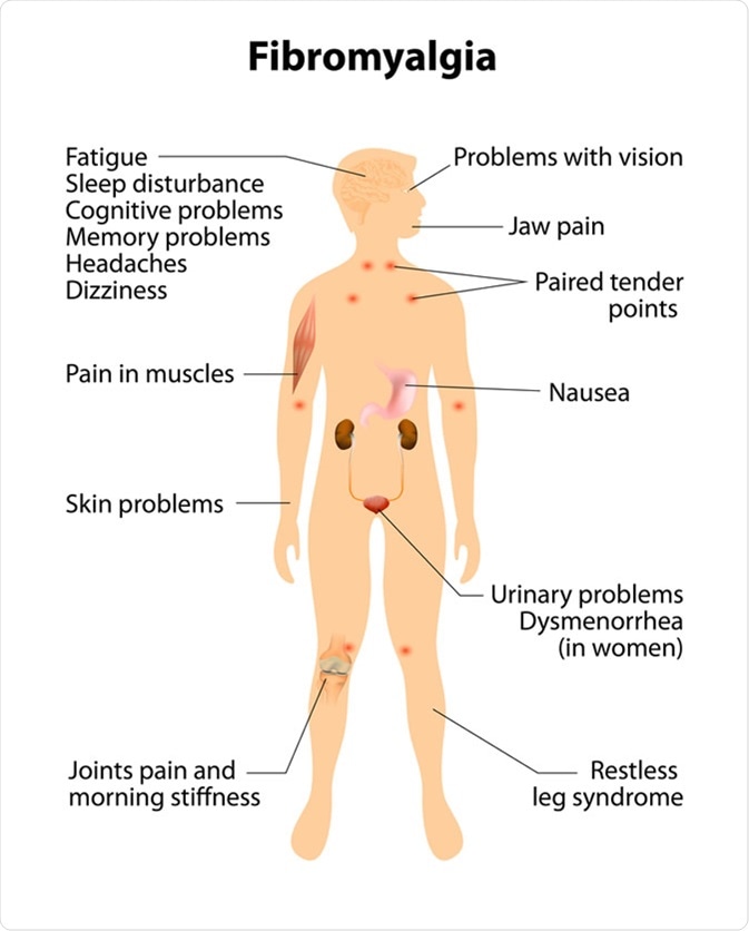 Signs and symptoms of fibromyalgia. Image Credit: Designua / Shutterstock