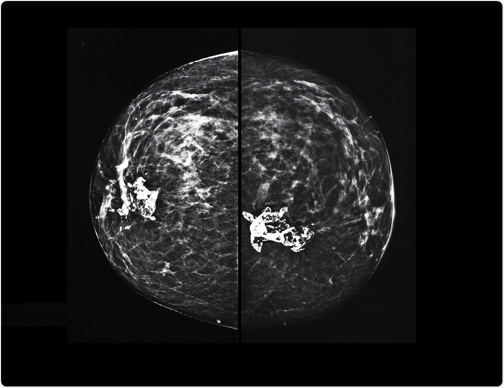 X-ray mammography of breast tissue