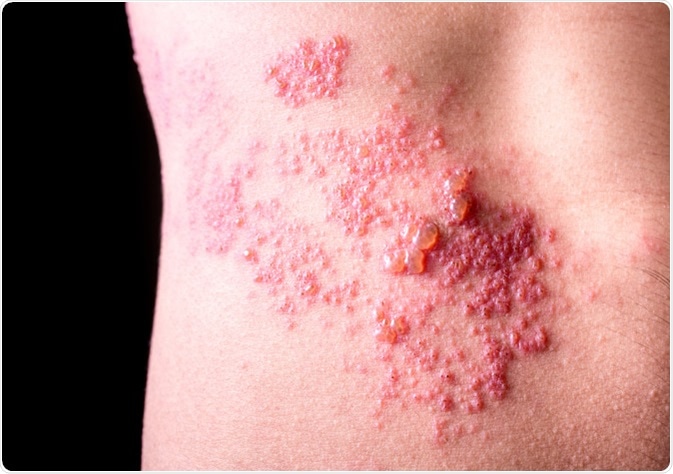 Raised red bumps and blisters caused by shingles on skin - Image Credit: Adtapon Duangnim / Shutterstock
