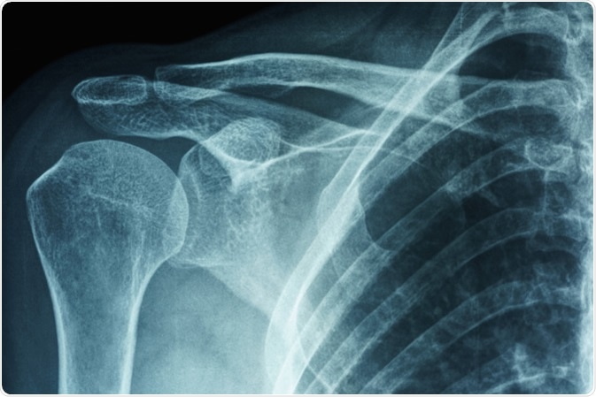 X-ray film of primary frozen shoulder or adhesive capsulitis of Asian female patient. Image Credit: PK289 / Shutterstock X-ray film of primary frozen shoulder or adhesive capsulitis of Asian female patient. Image Credit: PK289 / Shutterstock