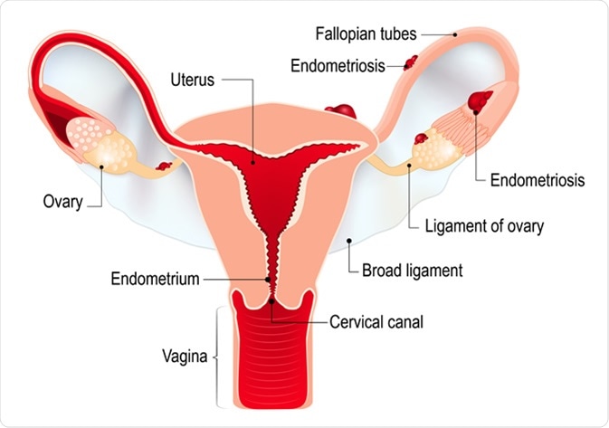 Endometriosis. Schematic drawing of various types of endometriosis disease. Image Credit: Designua / Shutterstock