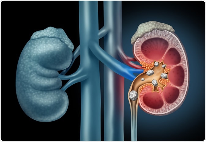 Human Kidney stones medical illustration. Image Credit: Lightspring / Shutterstock Human Kidney stones medical illustration. Image Credit: Lightspring / Shutterstock