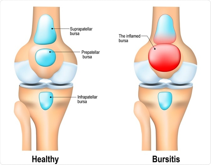Diagram showing bursitis versus healthy knee joint.