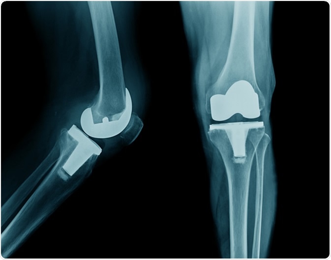 X-ray image total knee arthroplasty. Image credit: Tridsanu Thopet / Shutterstock
