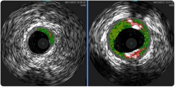 Shown are cross-sectional ultrasound images of coronary arteries from patients enrolled in a study. Plaque buildup (colored areas) in an artery from a patient that lacks sensitivity to red meat allergen (left) is much lower than plaque levels in an artery from a patient with sensitivity to red meat allergen (right). Courtesy of Angela Taylor, M.D., University of Virginia Health System