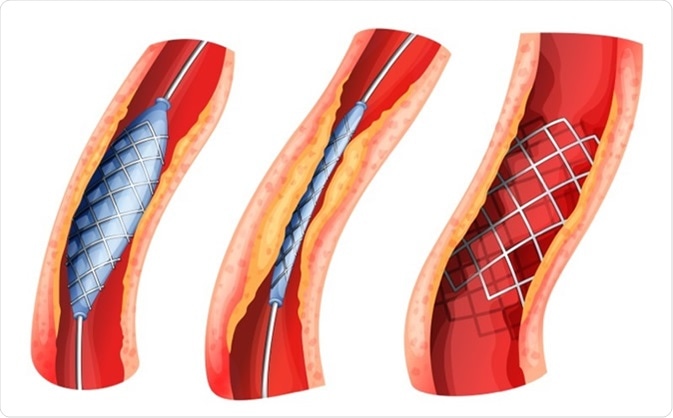 Illustration of a stent used to open blocked artery  Image Credit: BlueRingMedia / Shutterstock