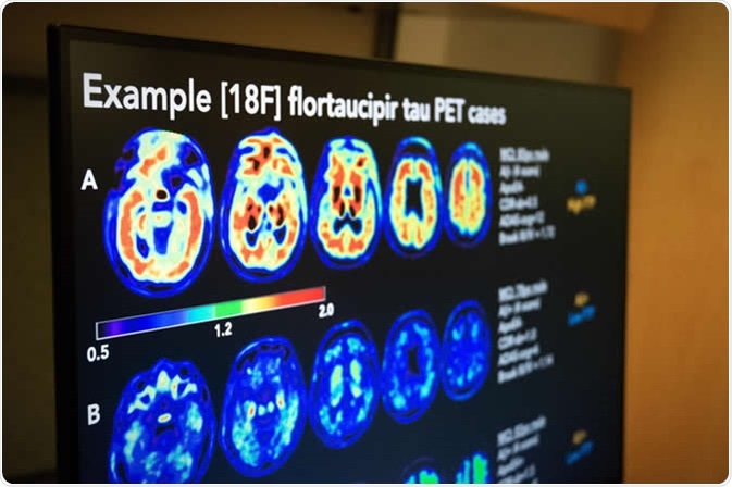 U.S. POINTER randomized controlled trial assessed PET imaging to measure the buildup of amyloid and tau, two proteins whose accumulation in the brain has been linked to Alzheimer