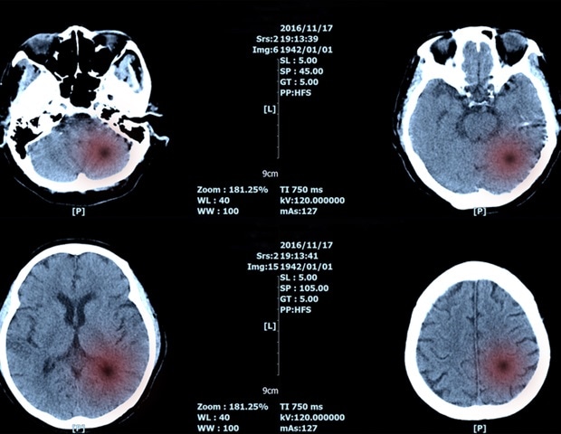 Novel artificial intelligence algorithm helps detect brain tumor