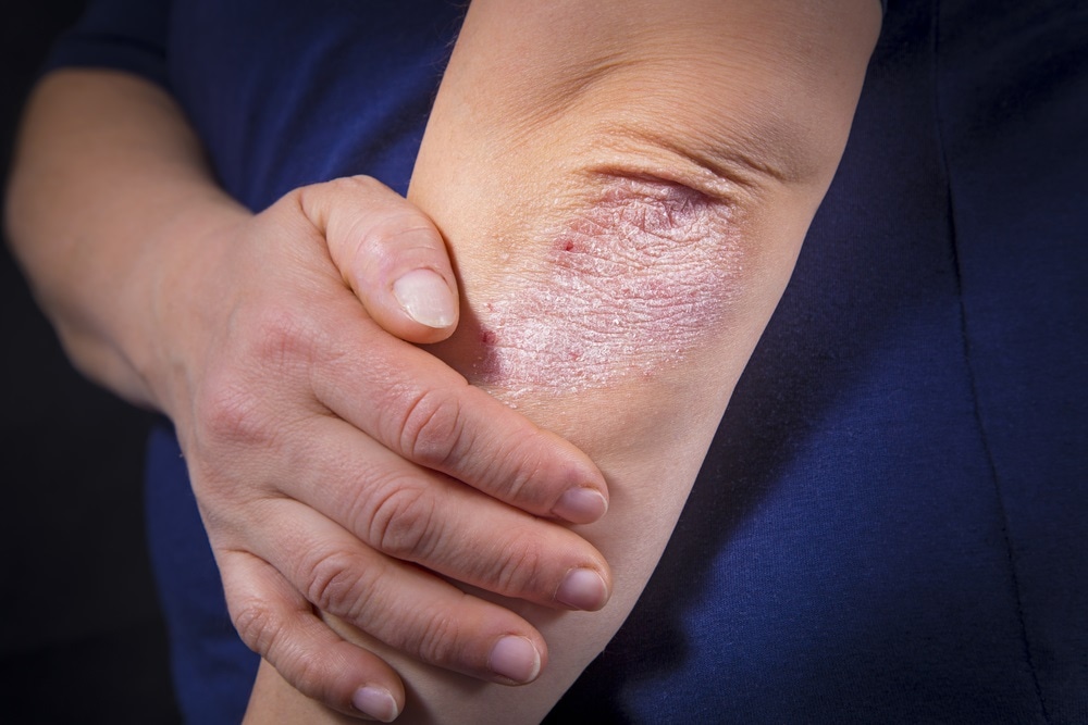 psoriasis treatment uk