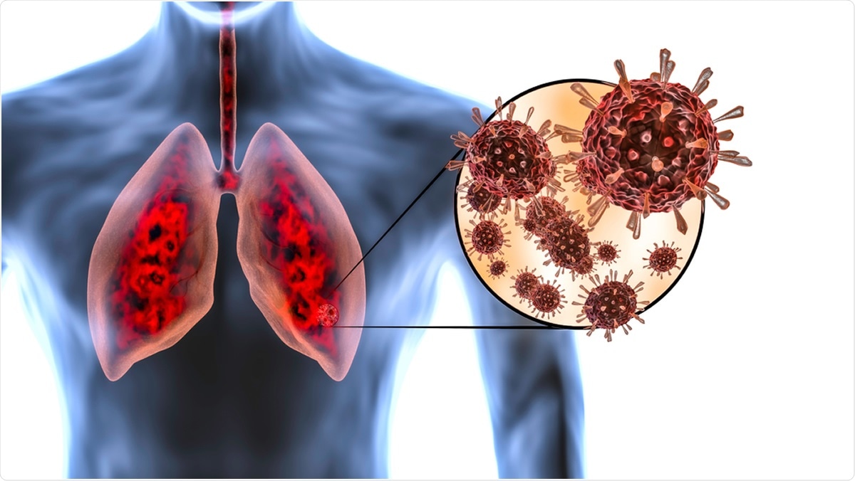 Persistent and extensive lung damage seen in COVID-19 patients