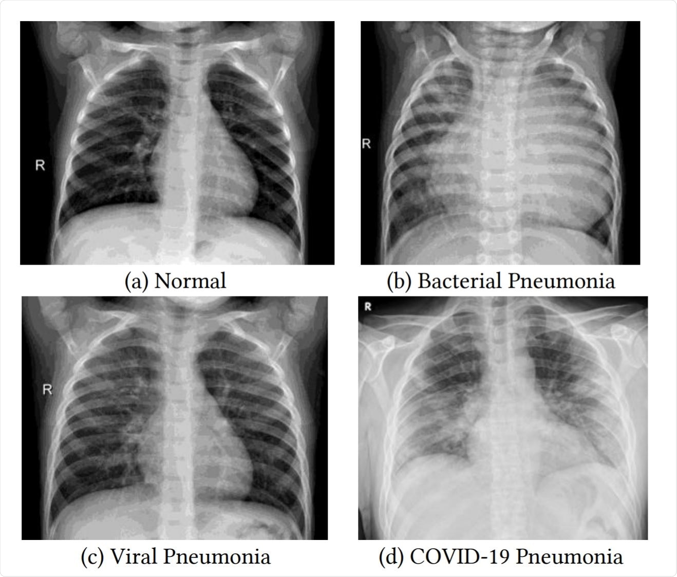 chest x ray pneumonia