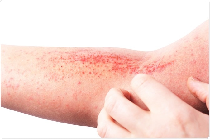 atopic eczema)