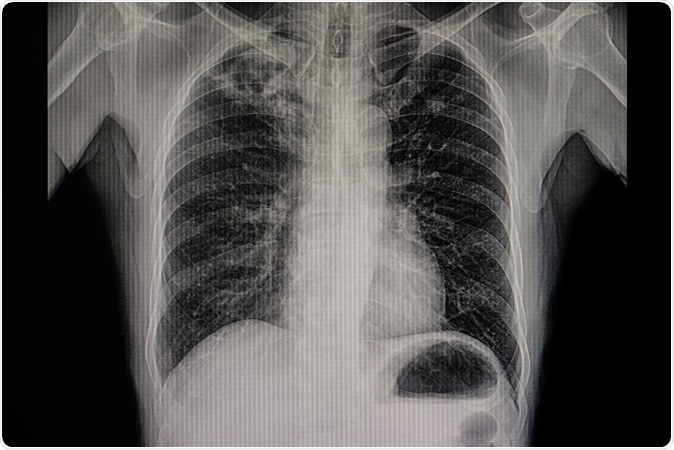 La nueva terapia de la inhalación podía relevar fibrosis del ...