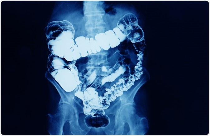 rectal cancer x ray)