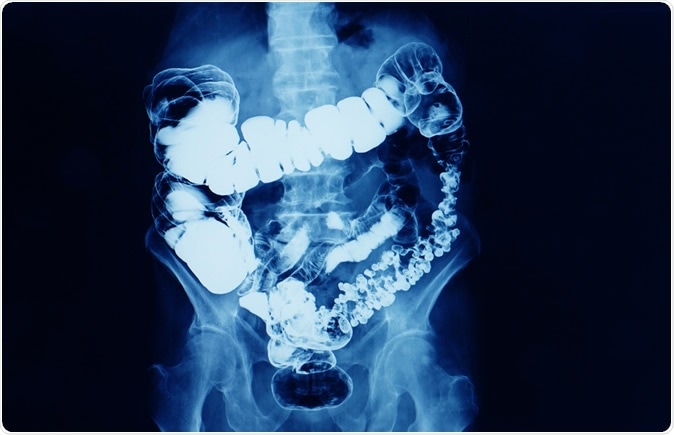 cancer colon jeune adulte hogyan lehet megfelelően eltávolítani a parazitákat a testből