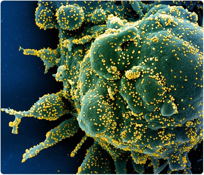 Color scanning electron micrograph of apoptotic cells (green) strongly infected with SARS-COV-2 virus particles (yellow) isolated from a sample from a patient with a novel coronavirus SARS-CoV-2. Image taken at the NIAID Integrated Research Facility (IRF) in Fort Detrick, MD. Credit: NIAID