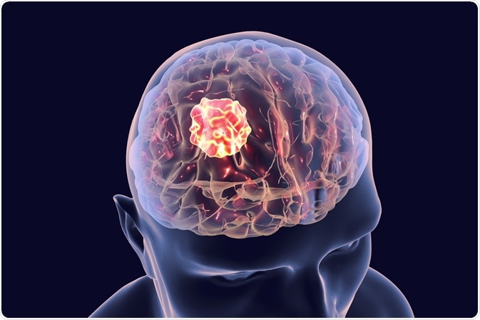 Treating Brain Tumors