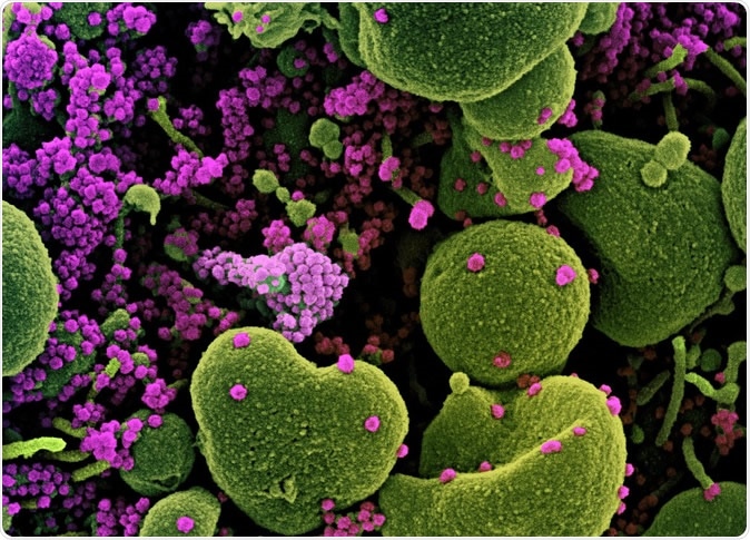 Novel Coronavirus SARS-CoV-2 Colorized scanning electron micrograph of an apoptotic cell (green) heavily infected with SARS-COV-2 virus particles (purple), isolated from a patient sample. Image captured at the NIAID Integrated Research Facility (IRF) in Fort Detrick, Maryland. Credit: NIAID