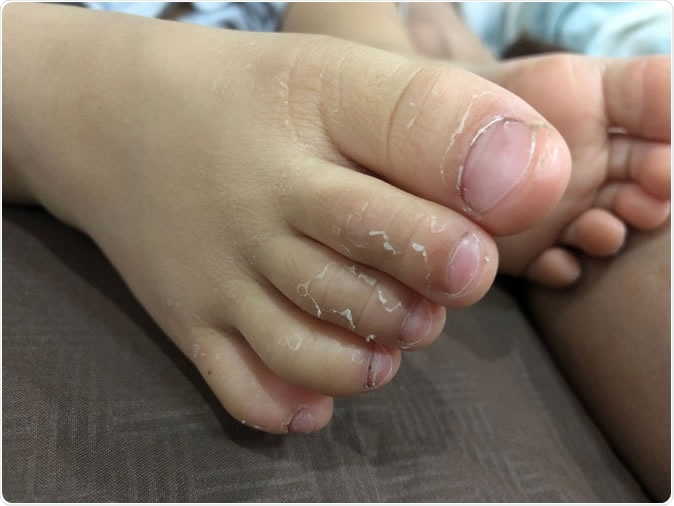 Study: Outbreak of Kawasaki disease in children during COVID-19 pandemic: a prospective observational study in Paris, France. Image Credit: PJUTISIR / Shutterstock