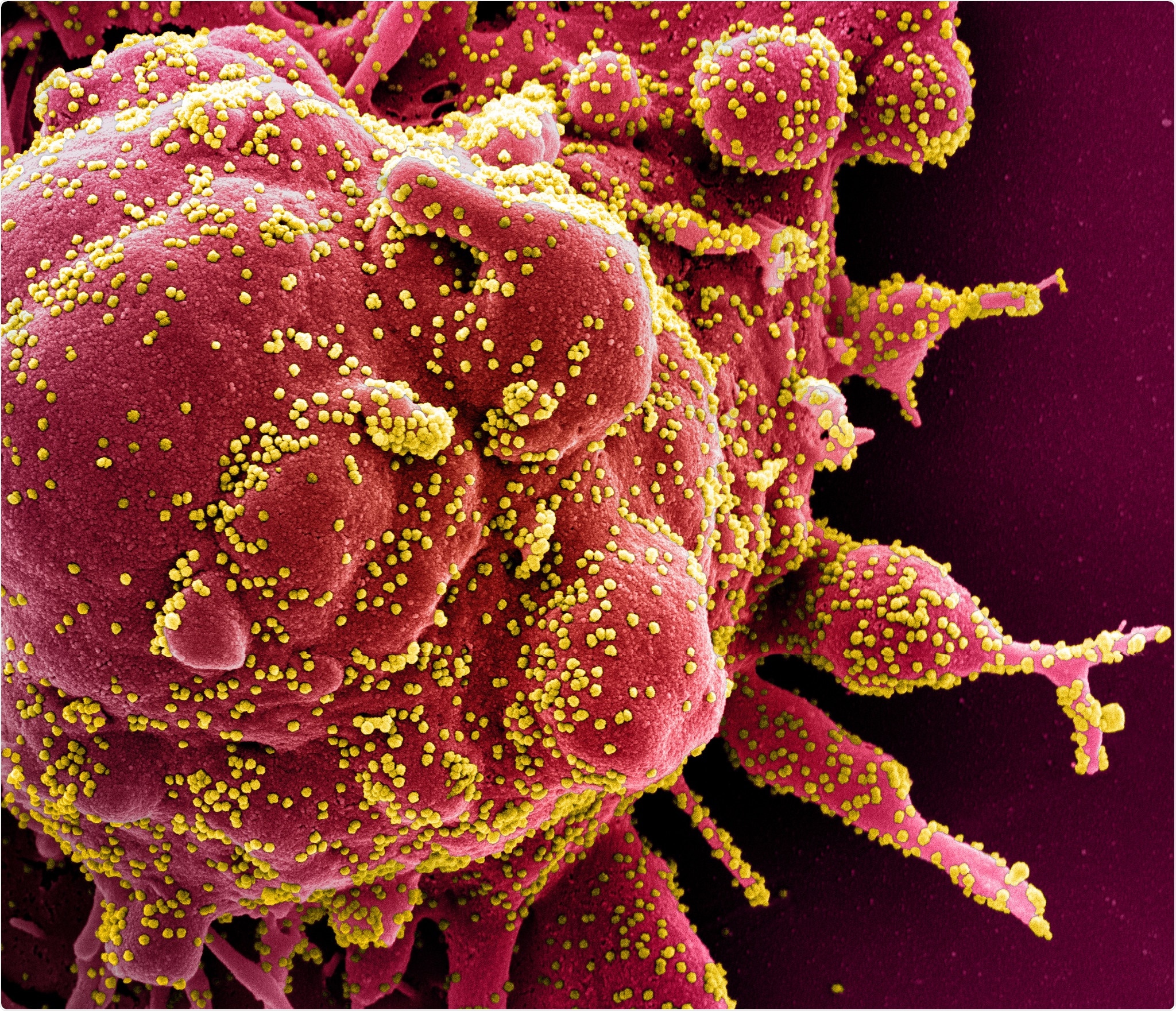 Novel Coronavirus SARS-CoV-2 Colorized scanning electron micrograph of an apoptotic cell (red) heavily infected with SARS-COV-2 virus particles (yellow), isolated from a patient sample. Image captured at the NIAID Integrated Research Facility (IRF) in Fort Detrick, Maryland. Credit: NIAID