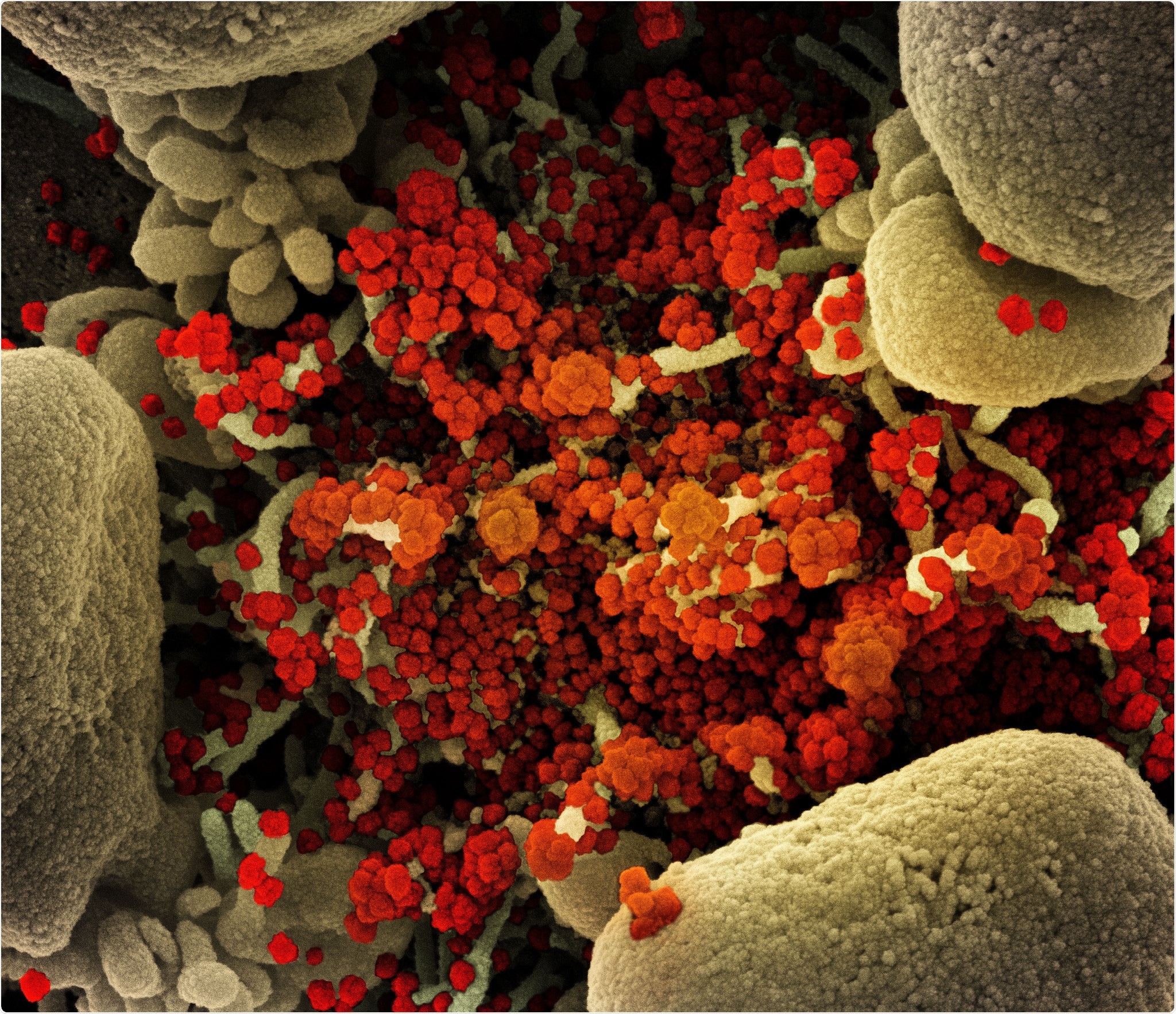 Novel Coronavirus SARS-CoV-2 Colorized scanning electron micrograph of an apoptotic cell (tan) heavily infected with SARS-COV-2 virus particles (orange), isolated from a patient sample. Image captured at the NIAID Integrated Research Facility (IRF) in Fort Detrick, Maryland. Credit: NIAID