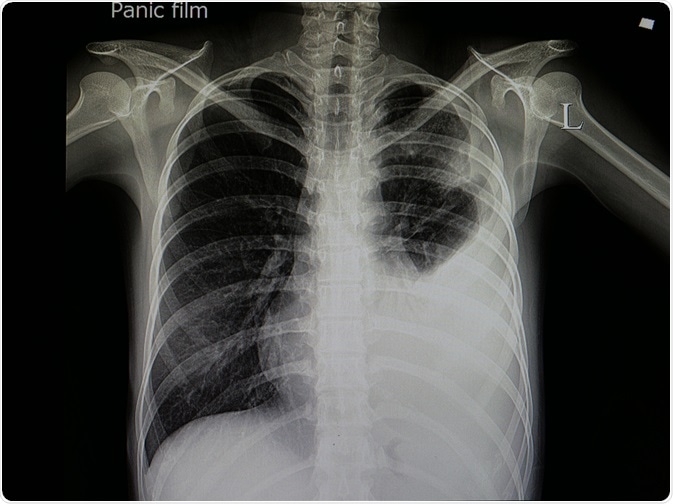 chest x ray pneumonia