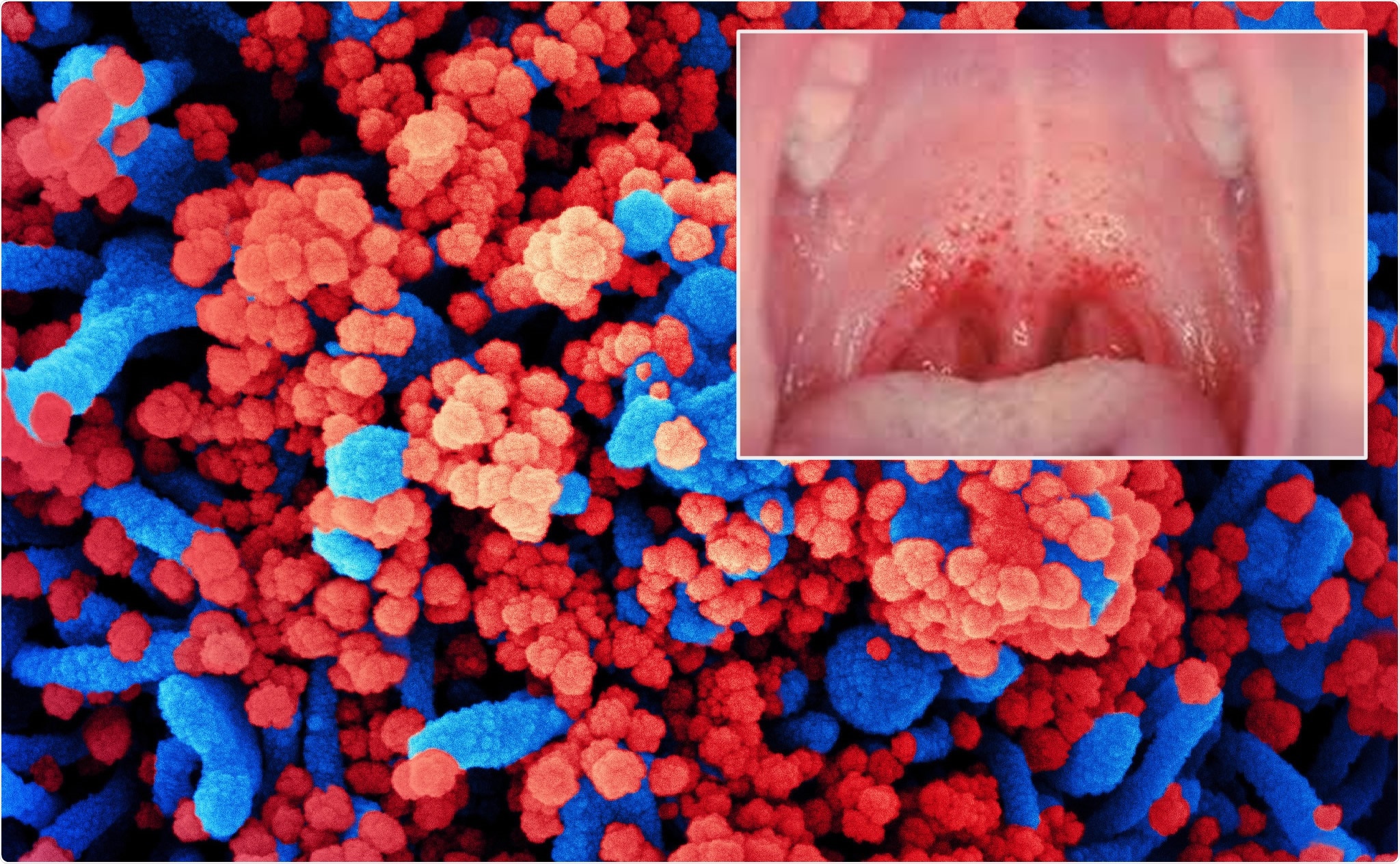 new sign of COVID-19: a in the mouth