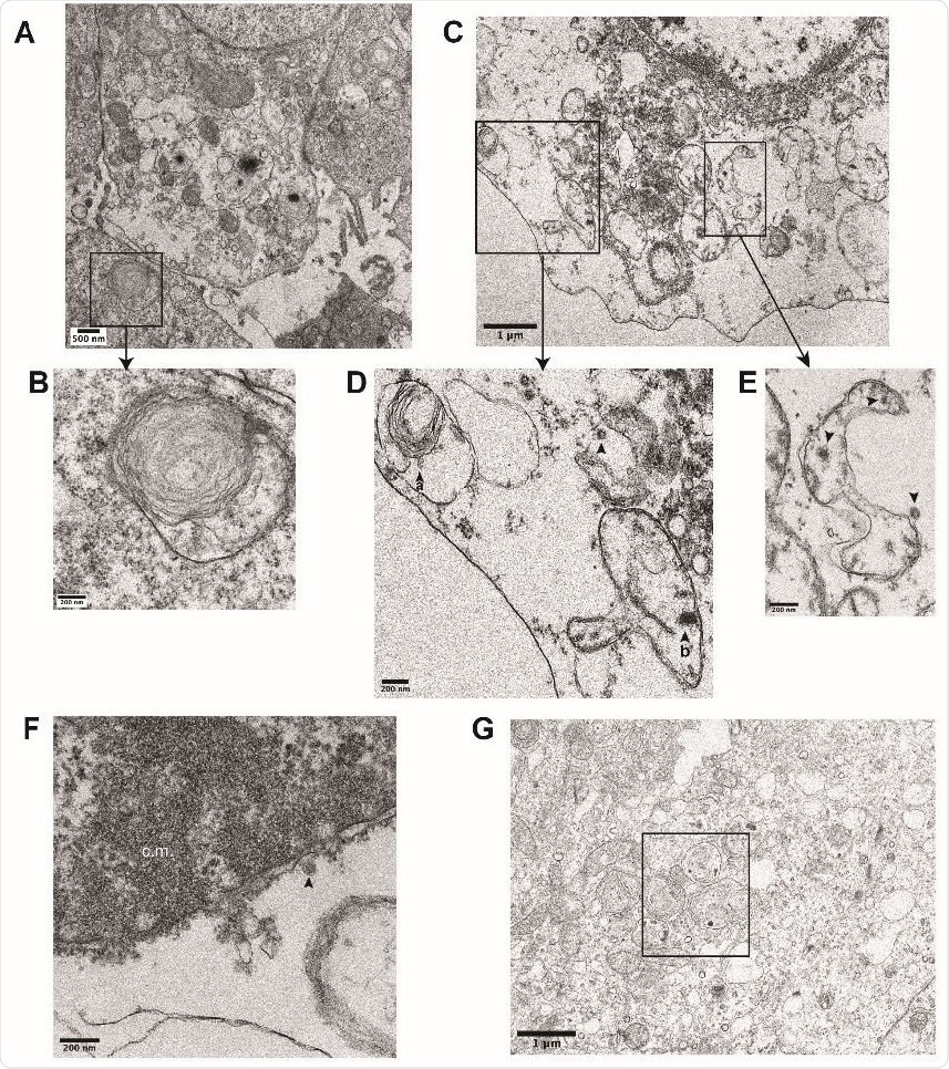 Ultrastructural analysis of iAT2s infected with SARS-CoV-2. (B) Transmission electron micrographs of mock-infected iAT2s at ALI (A-B) demonstrating lamellar body expression but no detectable virions. iAT2s at ALI infected with SARS-CoV-2 at an MOI of 140 and fixed 1 dpi (CG) contain visible virions (C-E, G, arrowheads) in the cytoplasm (D,E), within lamellar bodies (D, arrowhead a) (G, see Fig. 2J for inset), and within double-membrane bound structures (D, arrowhead b) (E, arrowheads). Virions are also found extracellularly (F, arrowhead) and some iAT2s contain convoluted membranes (F, c.m.).