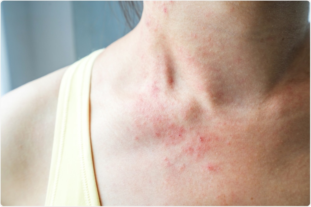 Skin Rash May Be A Symptom Of Covid 19