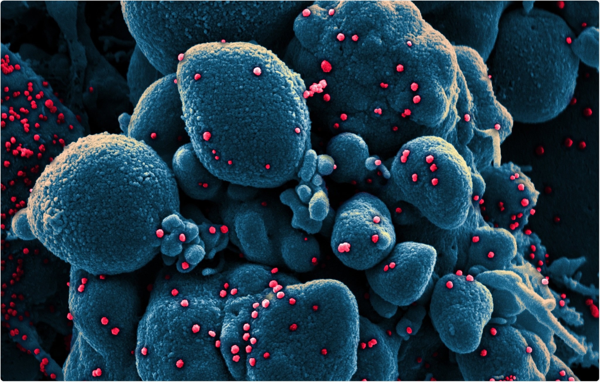 Colorized scanning electron micrograph of an apoptotic cell (blue) infected with SARS-COV-2 virus particles (red), isolated from a patient sample. Image captured at the NIAID Integrated Research Facility (IRF) in Fort Detrick, Maryland. Credit: NIAID